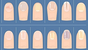 Bana tırnağını göster sana hastalığını söyleyeyim | Milyonlarca izlenen videodan sonra gündem tırnaklar...