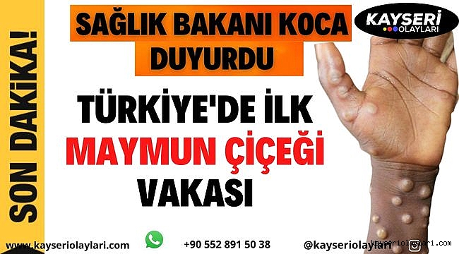 Sıcak Haber!!! Bakan Koca Duyurdu! Maymun çiçeği virüsü Türkiye'de 