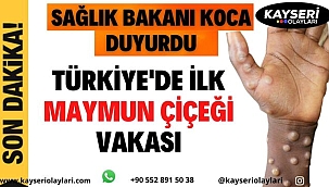 Sıcak Haber!!! Bakan Koca Duyurdu! Maymun çiçeği virüsü Türkiye'de 