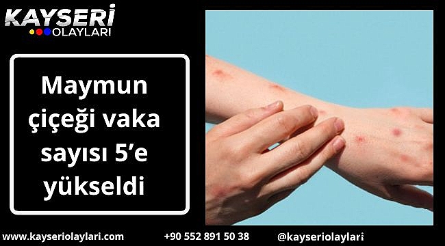 Maymun çiçeği vaka sayısı 5'e yükseldi
