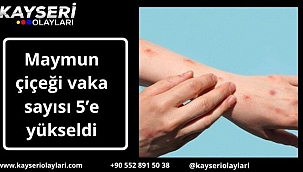 Maymun çiçeği vaka sayısı 5'e yükseldi