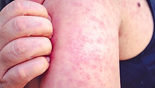  Çocuklardan sonra yetişkinler de risk altında! Peki nasıl korunacağız?